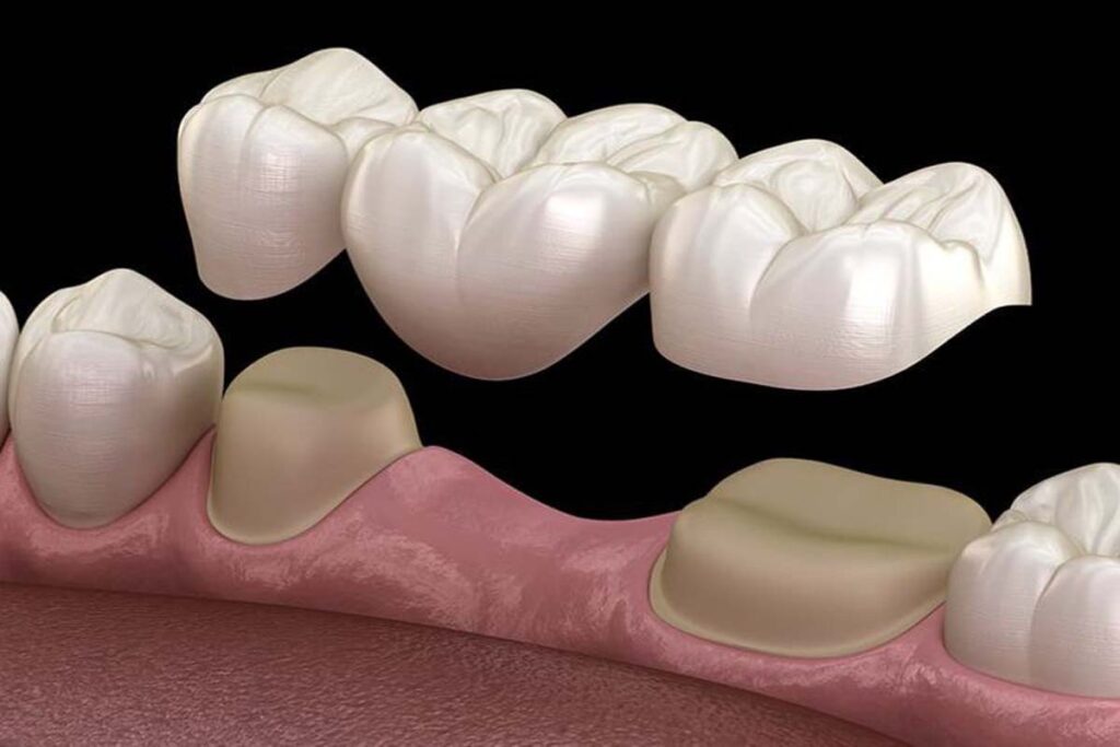 dental bridges in sw calgary