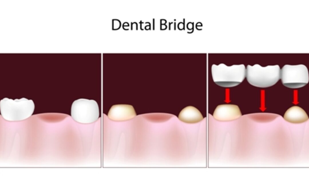 Why You Should Opt for Dental Bridges
