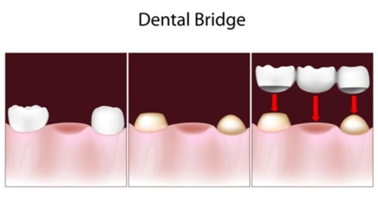 why-you-should-opt-for-dental-bridges