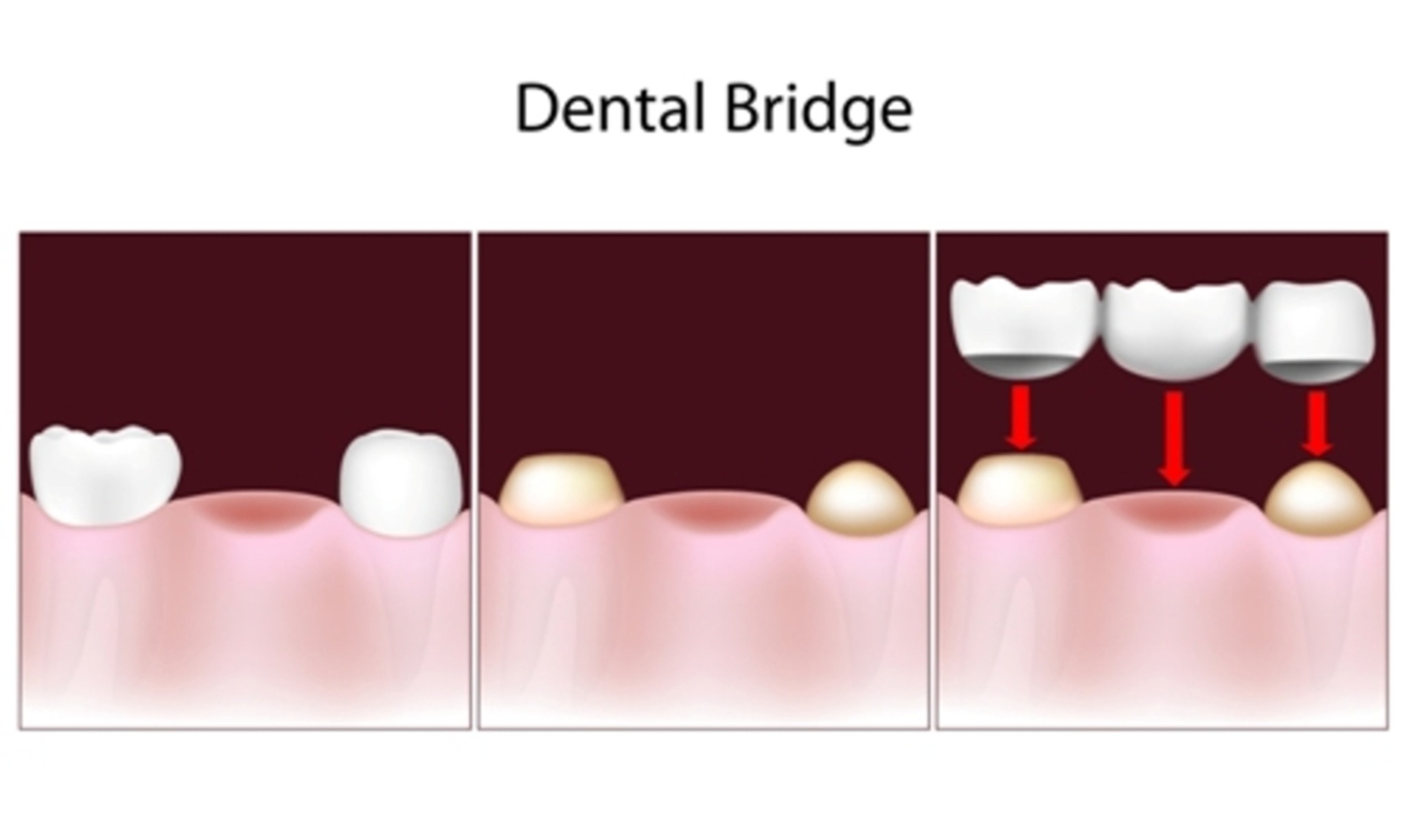 why-you-should-opt-for-dental-bridges