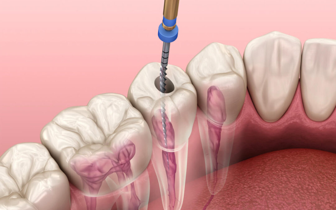 Signs of Root Canal Failure