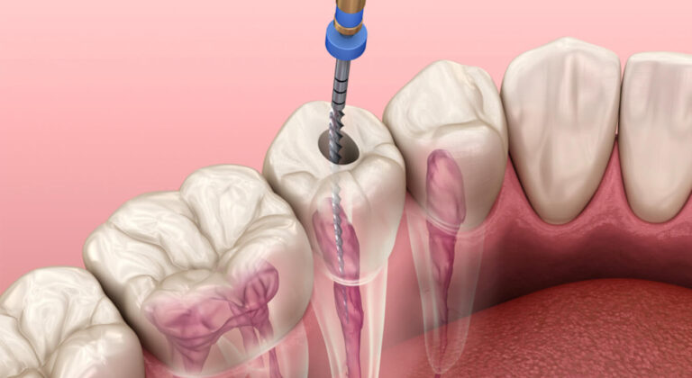 root canal therapy in sw calgary