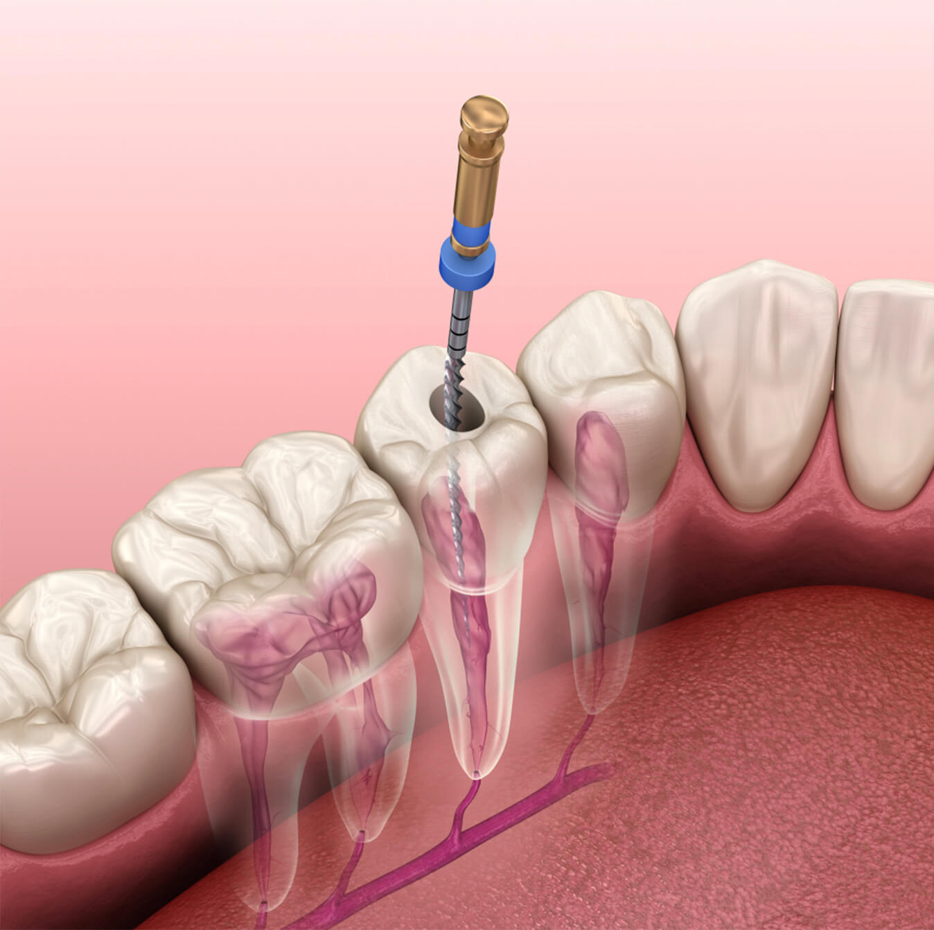 root canal therapy in sw calgary