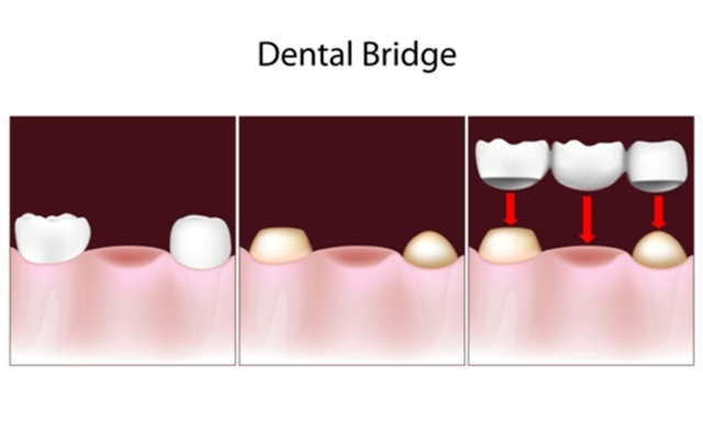 Dental Bridges in SW Calgary